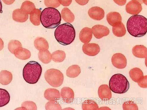 急性髓細(xì)胞白血病未成熟型（M1)